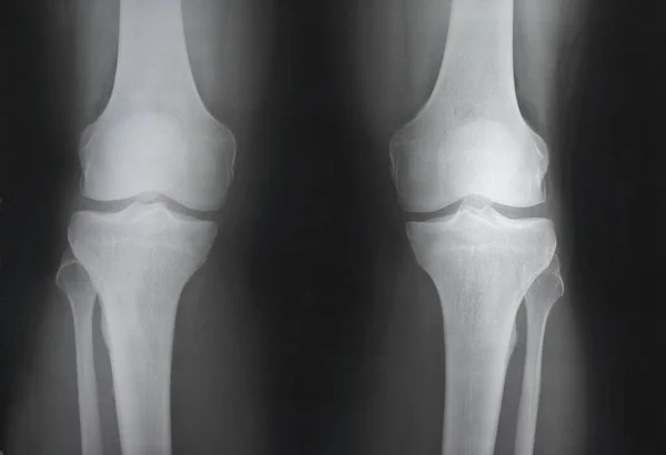 Bir Doktor Tarafından Muayene Edilmek Için Dizinin Röntgeni Kırıklar Bacak Stok Resim