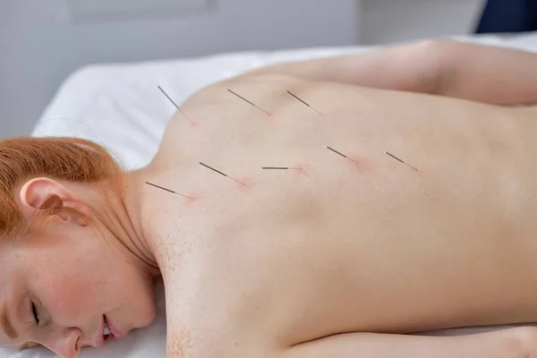 acupuncture therapy on back spine shoulders for woman client. female undergoing acupuncture treatment with a line of fine needles inserted into slim body skin in clinic hospital, lying on couch