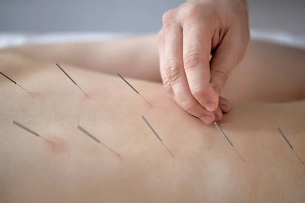 Cropped Acupuncturist Treats Female Patients Illness Acupuncture Special Points Back — Foto Stock