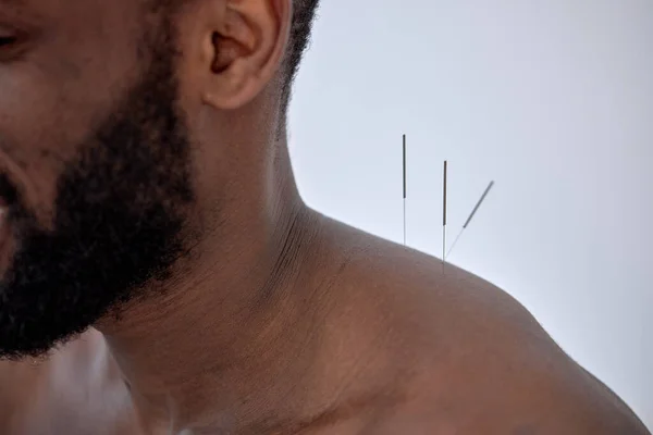 acupuncture therapy on back spine shoulders for black client. cropped young man undergoing acupuncture treatment with a line of fine needles inserted into body skin in clinic hospital, close-up