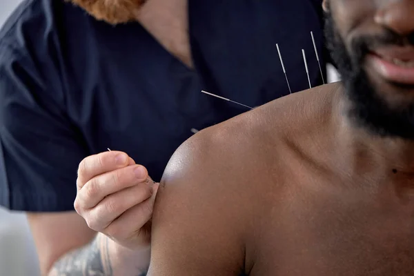 Acupuncture Therapy Back Spine Shoulders Black Client Cropped Young Man — Foto Stock