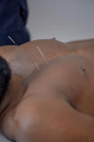 Acupuncture Chest Black Man Cropped Male Massagist Making Osteoarthritis Treatment — Foto Stock