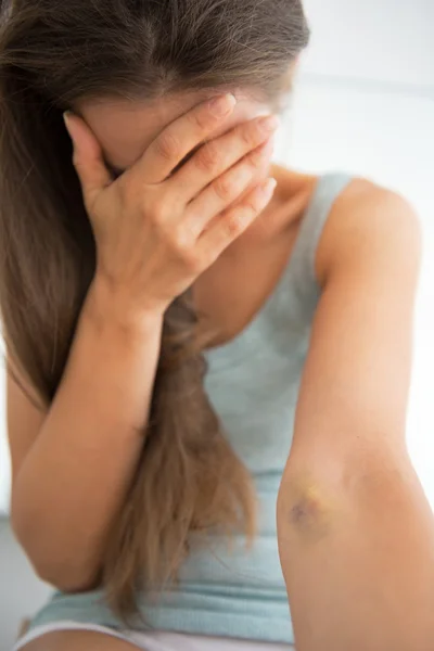 Drug addict young woman with bruise — Stock Photo, Image