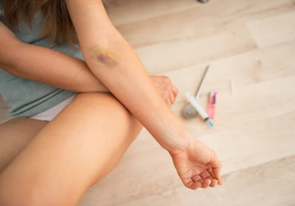 Bruise hand of drug addict woman — Stock Photo, Image