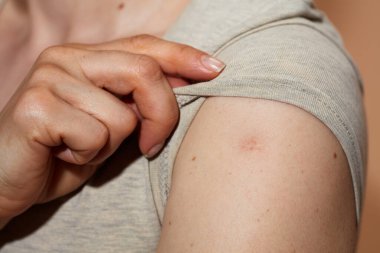 Closeup on female with smallpox vaccine scar against beige background.