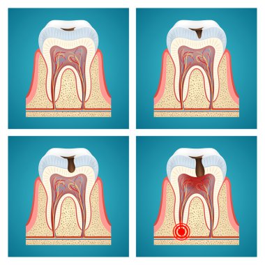 Stages progress dental caries and toothache clipart