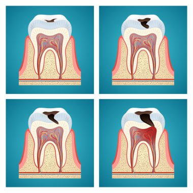 Stages progress dental caries clipart