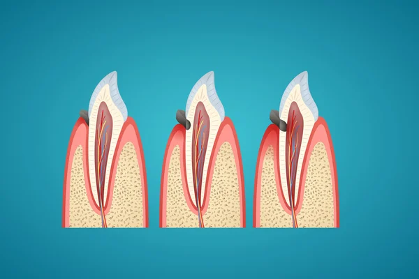 Etapas caries progreso en canino humano — Archivo Imágenes Vectoriales