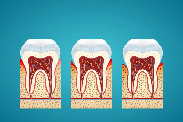 üç insan diş eti hastalığı ile kesit içinde