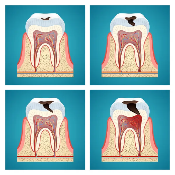 Στάδια προόδου οδοντική τερηδόνα — Διανυσματικό Αρχείο