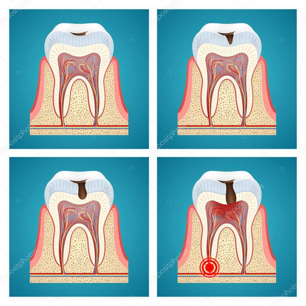 Stages progress dental caries and toothache