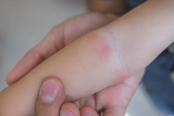 Mulher mão segurando perna infantil. Alergia da pele seca vermelha da fórmula de leite ou outros alimentos. Fechar.. — Fotografia de Stock