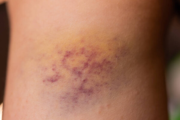 Крупный план Синяк на раненой женской коже ноги.