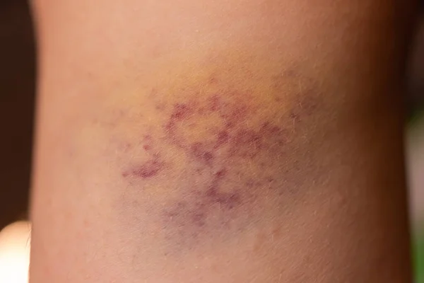 Closeup Hematomas na pele da perna das mulheres feridas. — Fotografia de Stock