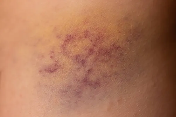 Closeup Hematomas na pele da perna das mulheres feridas. — Fotografia de Stock