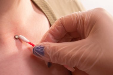 Mikro dermal piercing yerleştirme operasyonu. Profesyonel yerleştirme