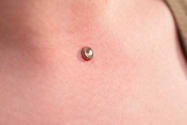 Mikro dermal piercing yerleştirme operasyonu. Profesyonel yerleştirme
