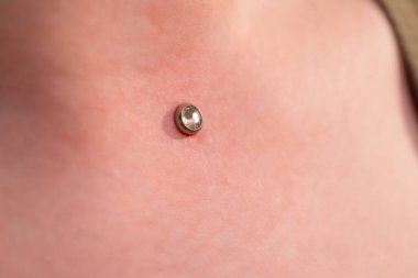 Mikro dermal piercing yerleştirme operasyonu. Profesyonel yerleştirme