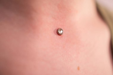 Mikro dermal piercing yerleştirme operasyonu. Profesyonel yerleştirme