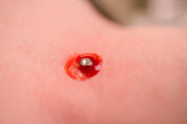 Mikro dermal piercing yerleştirme operasyonu. Profesyonel yerleştirme