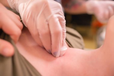 Mikro dermal piercing yerleştirme operasyonu. Profesyonel yerleştirme