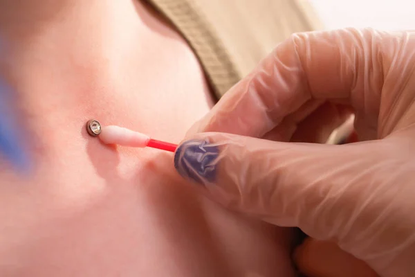 Operatie om microdermale piercing te installeren. Beroepsplaatsing — Stockfoto