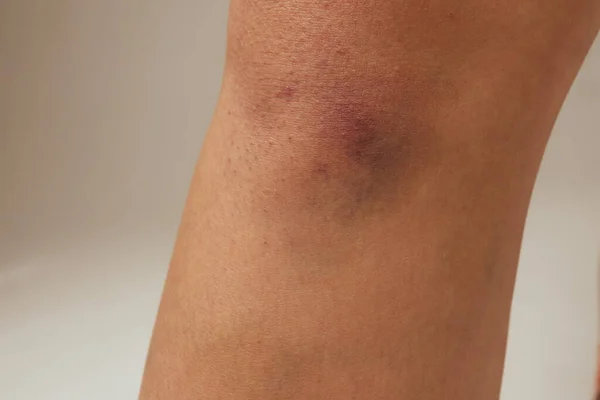 Hematoma and Large Bruise, blood under skin Congestion. — 图库照片