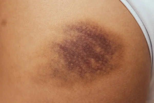 Hematoma y hematomas grandes, sangre debajo de la piel Congestión. —  Fotos de Stock