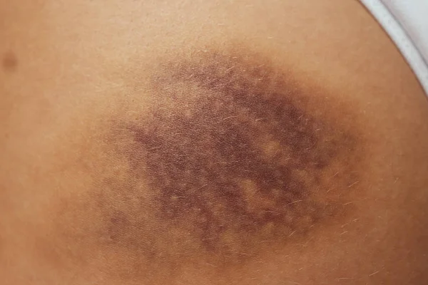 Hematoma and Large Bruise, blood under skin Congestion. — 图库照片