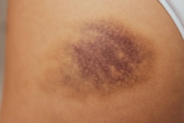Hematoma and Large Bruise, blood under skin Congestion. — Stock Photo, Image