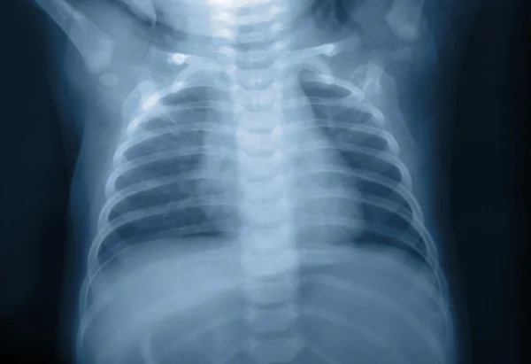Çocuk x-ray