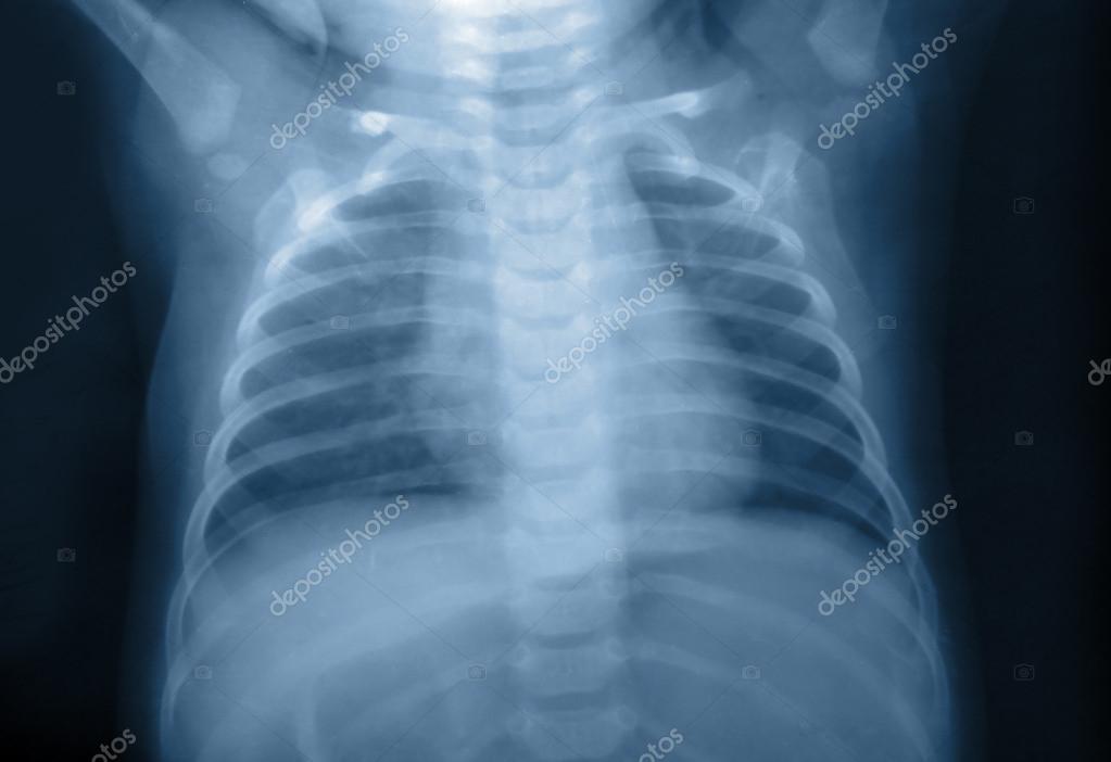 Child Xray Stock Photo by ©romdersen 18768539