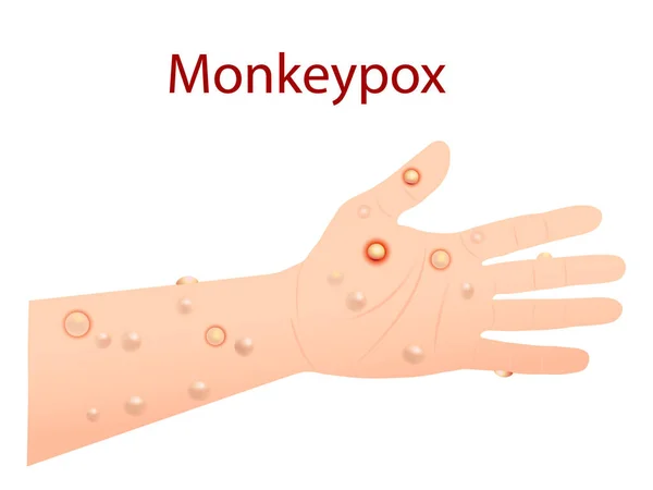 Vírus Varíola Macaco Que Pode Infectar Humanos Varíola Macaco Ilustração — Vetor de Stock