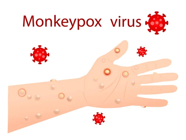 Wirus Ospy Małpiej Który Może Zainfekować Człowieka Ospa Małp Ilustracja — Wektor stockowy