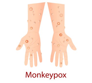 Monkeypox virus that can infect human, Monkey pox. Vector illustration clipart