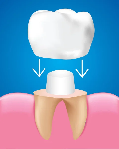 歯科クラウンの修復 歯科ケアの概念 現実的なデザインイラストベクトル — ストックベクタ