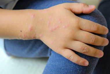 Viral Exanthem enfeksiyonu Erkek eli, Suçiçeği, Kızamık, Roseola İnfantum