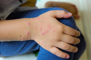 Viral Exanthem enfeksiyonu Erkek eli, Suçiçeği, Kızamık, Roseola İnfantum