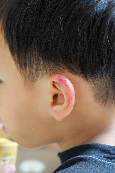 Viral Exanthem infection on Boy ear, Chicken Pox, Measles, roseola infantum