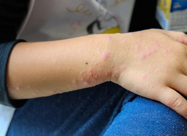 Viral Exanthem Infection Boy Hand Chicken Pox Measles Roseola Infantum — Zdjęcie stockowe