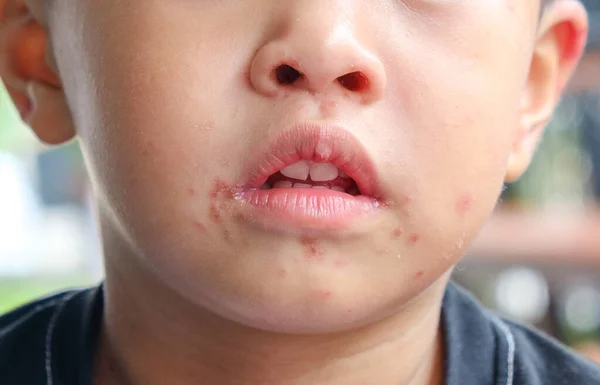 Viral Exanthem Infection Boy Face Chicken Pox Measles Roseola Infantum — стоковое фото