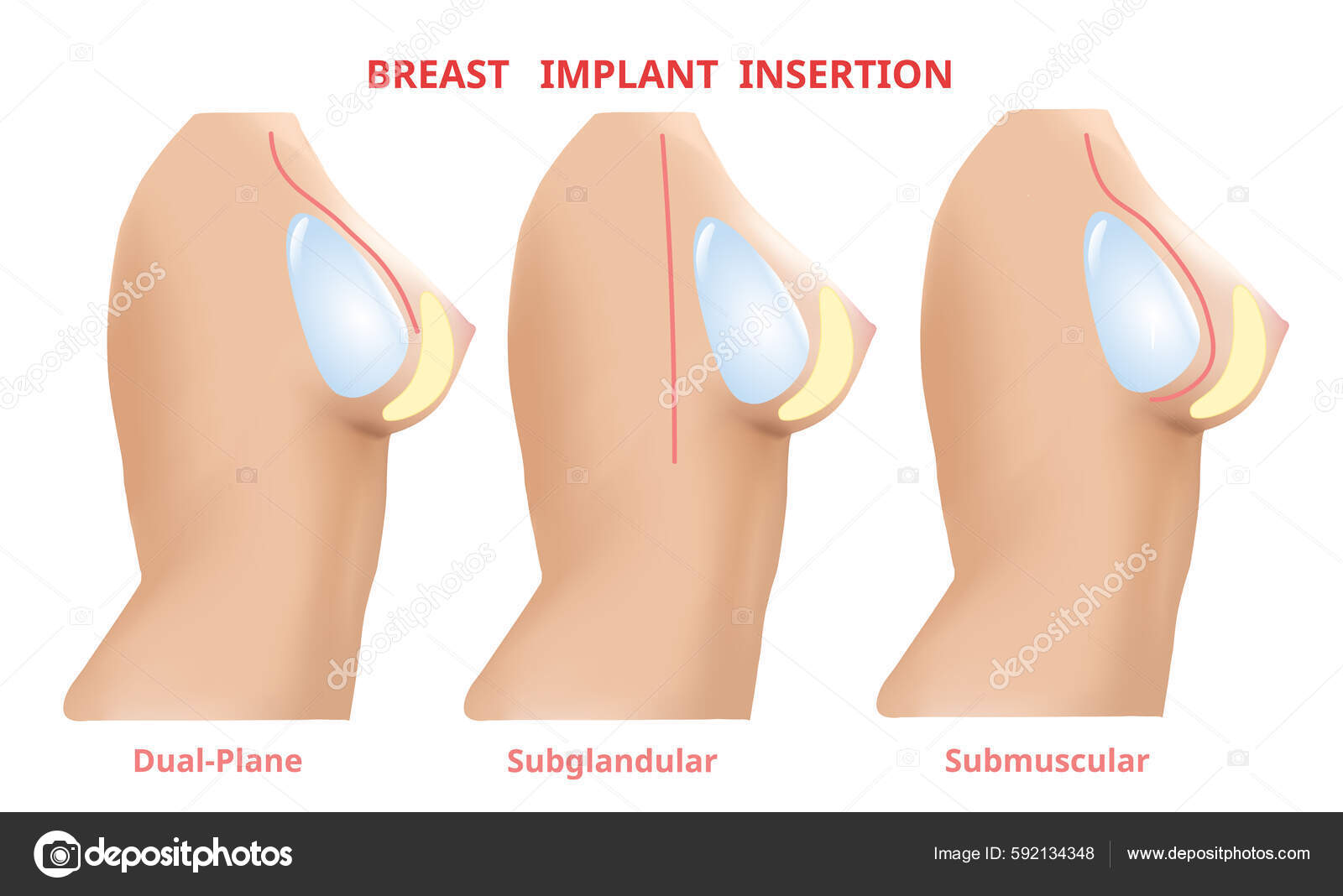 Different Shapes Of Breast, Women Breast, Vector Illustration