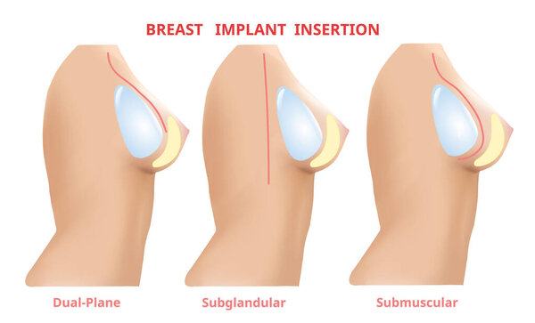 Breast implant insertion, Breast surgery silicone, 3D Realistic design Vector.