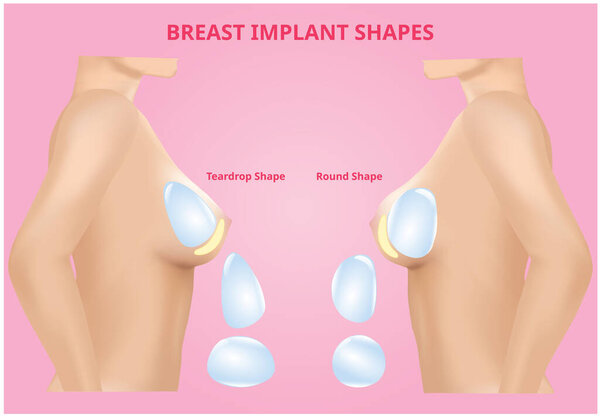 Silicone Breast Implants, compare round and tear drop, 3D Realistic design vector.