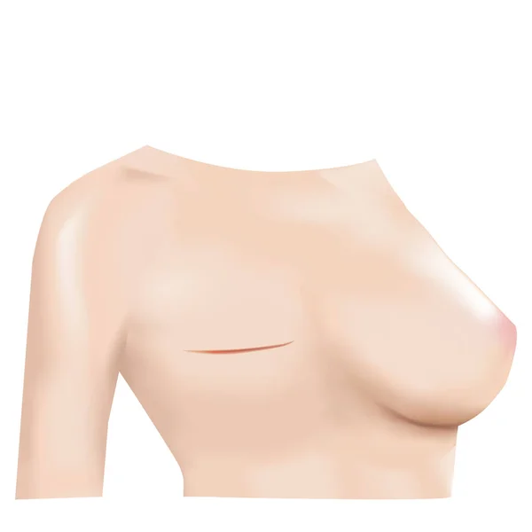 Breast Cancer Surgery Scars Lumpectomy Breast Cancer Removal Front View — 스톡 벡터