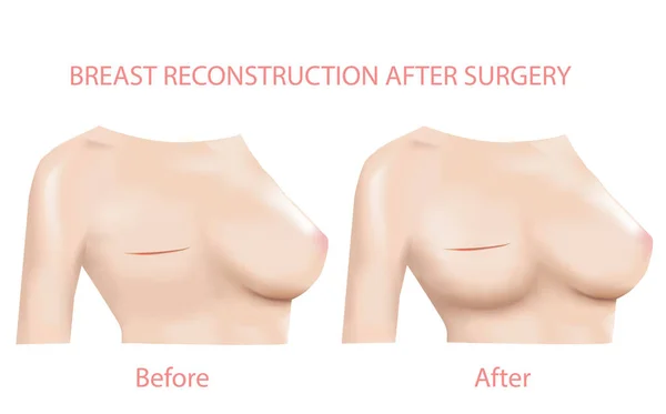 Rekonstruktion Der Brust Von Frauen Vor Und Nach Der Operation — Stockvektor