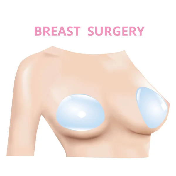 Breast Implant Silicone Insert Plastic Surgery Realistic Design Vector — Vetor de Stock
