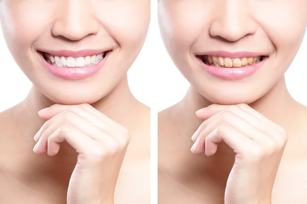 Woman teeth before and after whitening — Stock Photo, Image