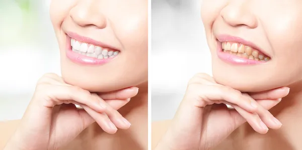 Dientes de mujer antes y después del blanqueamiento — Foto de Stock