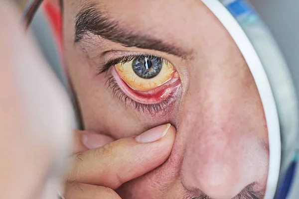 Human eye with yellow eyeball, closeup. Yellow eyes is a symptom of liver disease or hepatitis